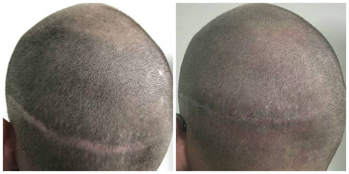 Tyler scar before and after micropigmentation