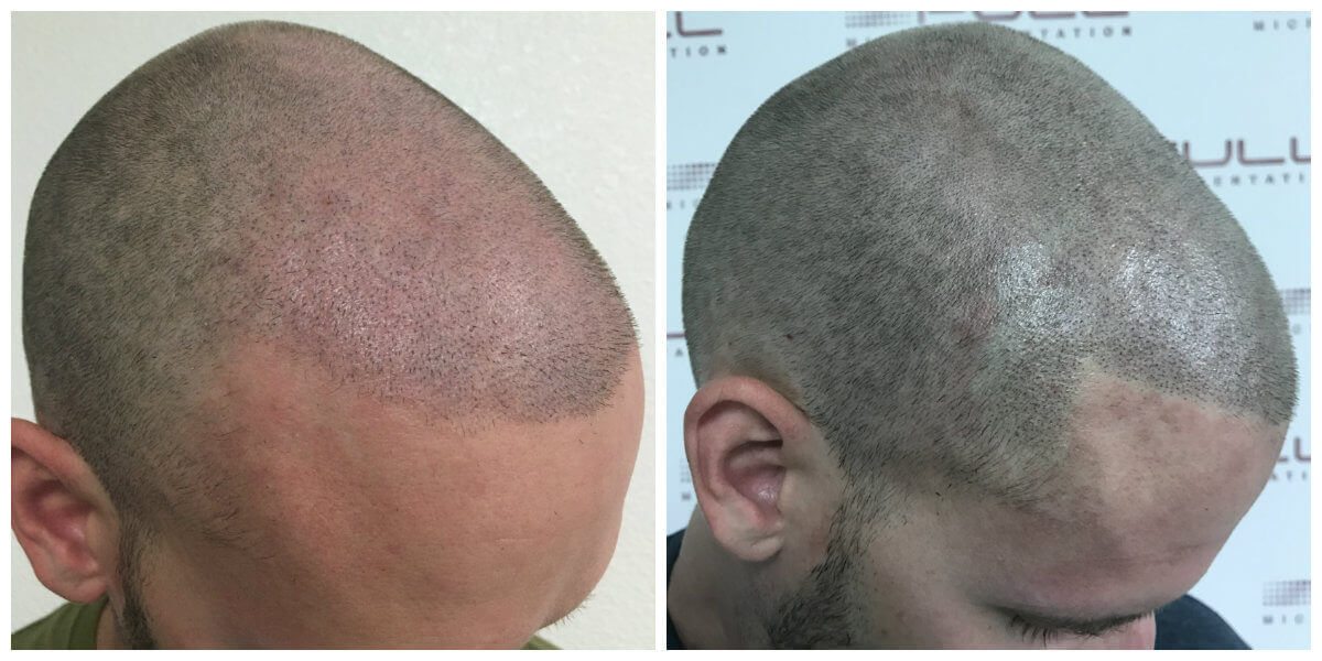 Tyler side before and after micropigmentation