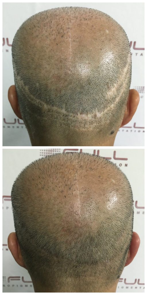 Hair Transplant Scar | Las Vegas - FULL Micropigmentation