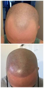 hairline-restoration
