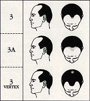 Scalp Micropigmentation Cost stage 3