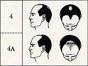 Scalp Micropigmentation Cost stage 4