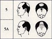 Scalp Micropigmentation Cost stage 5