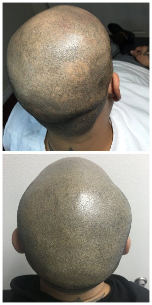 Treating Alopecia with SMP Treating Alopecia with SMP