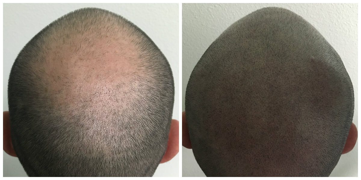 Stage 5 hair loss before and after