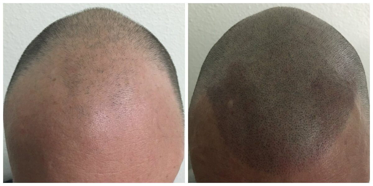 Stage 5 hair loss before and after