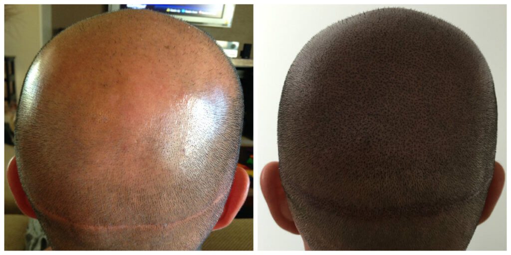 Hair Transplant Scar Repair