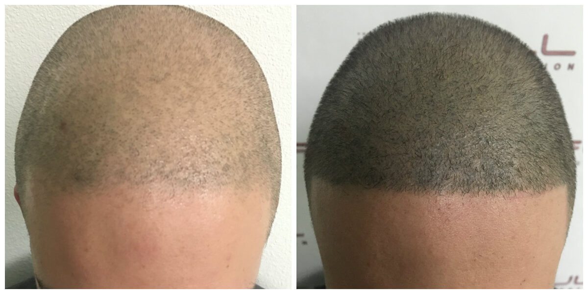 Max New Aug 2017 - Before and After Forehead