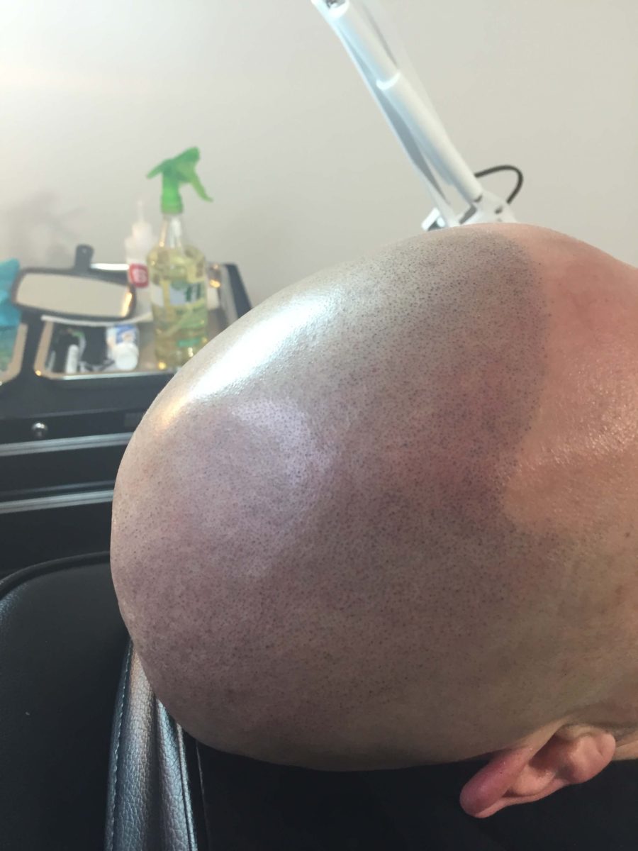 photo-mar-29-5-59-14-pm Scalp Micropigmentation for men