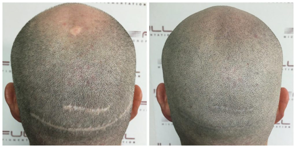 Scalp Micropigmentation - Adam - Before and After 2