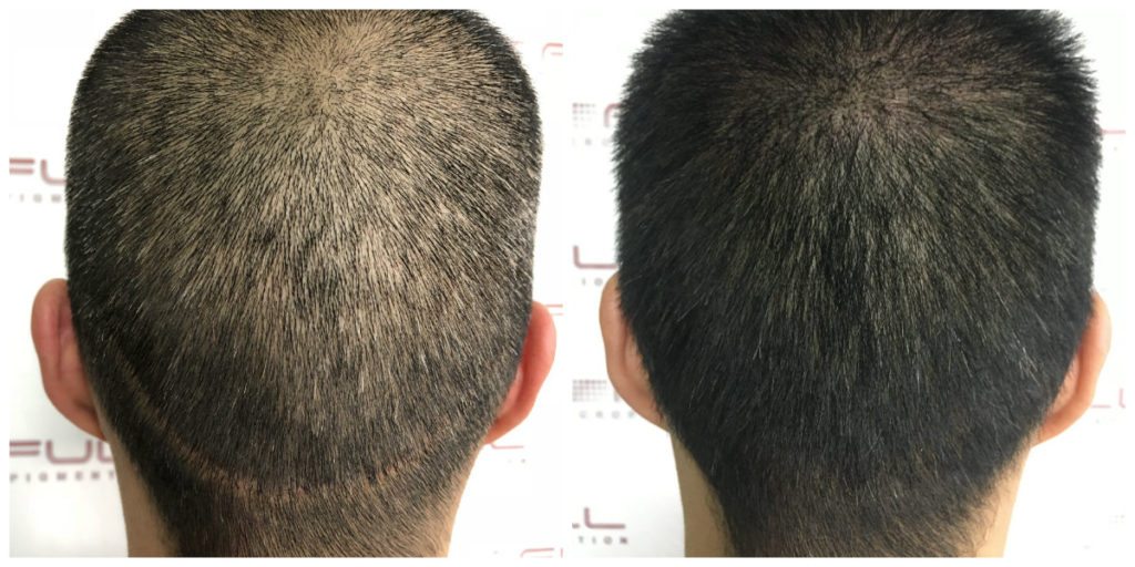 Scalp Micropigmentation Before and After - Las Vegas, NV - 7