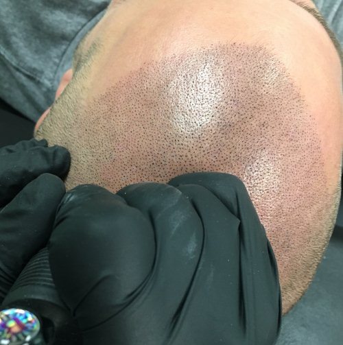 Scalp Micropigmentation in Progress - Las Vegas, NV Scalp Micropigmentation in Progress - Las Vegas, NV