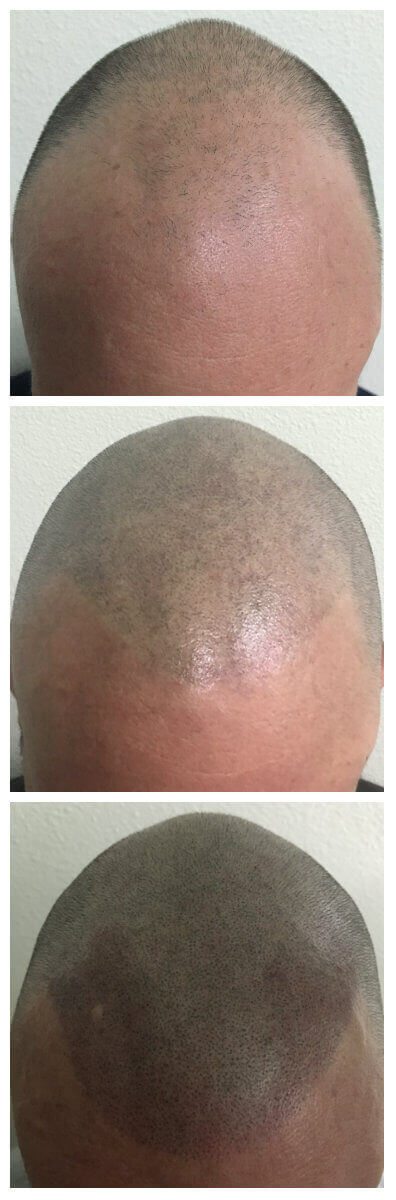 Chris G Hairline Restoration Chris G Hairline Restoration