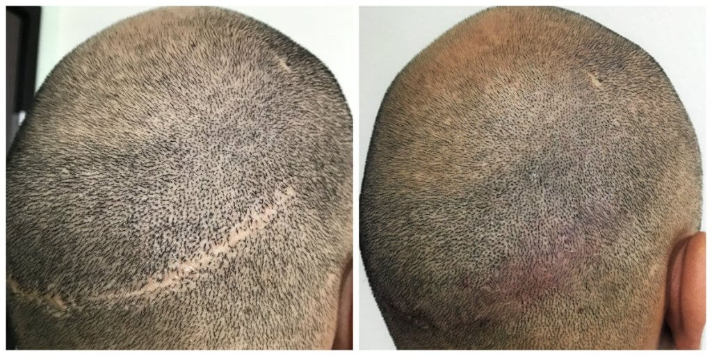 Hair Transplant Scar covering for Jonathon