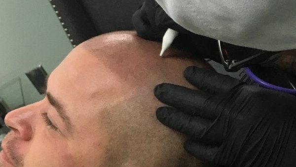 Best Needles - Marvin of FULL Micropigmentation in Las Vegas Best Needles - Marvin of FULL Micropigmentation in Las Vegas