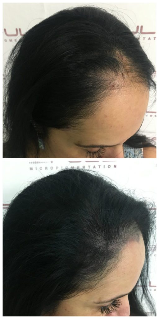 Client L female hair thinning Client L female hair thinning
