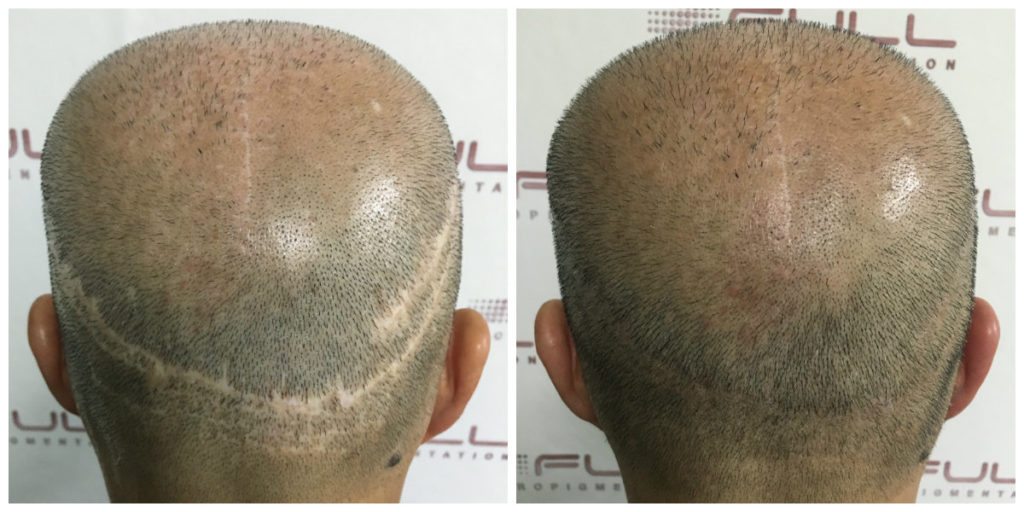 Hair Transplant Scar Repair - Bo