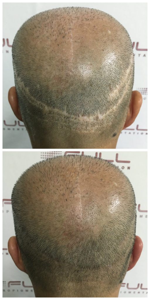 Hair Transplant Scar Repair Bo Hair Transplant Scar Repair Bo
