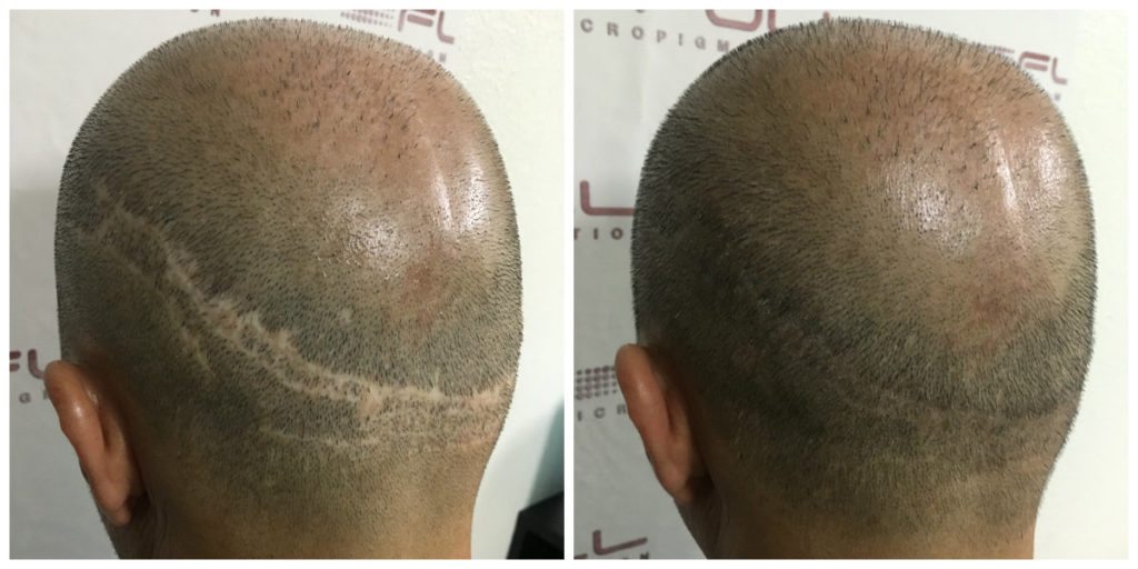 Hair Transplant Scar Repair Bo side