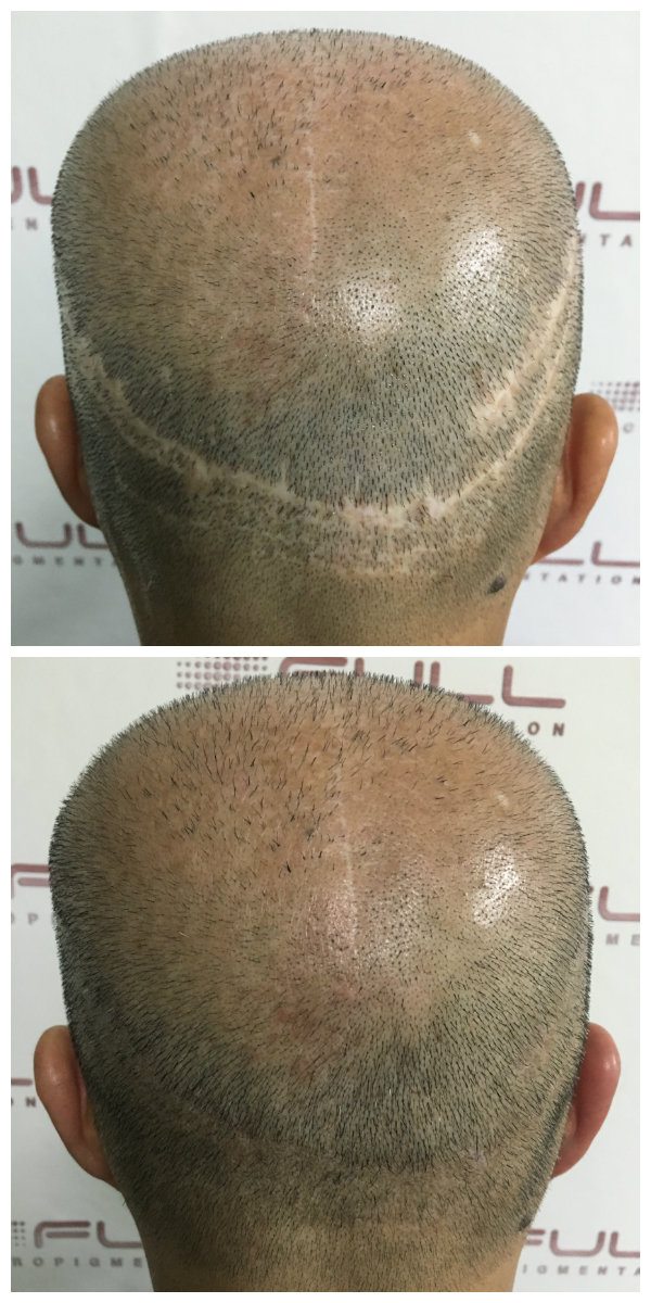 hair-transplant-scar-las-vegas-full-micropigmentation