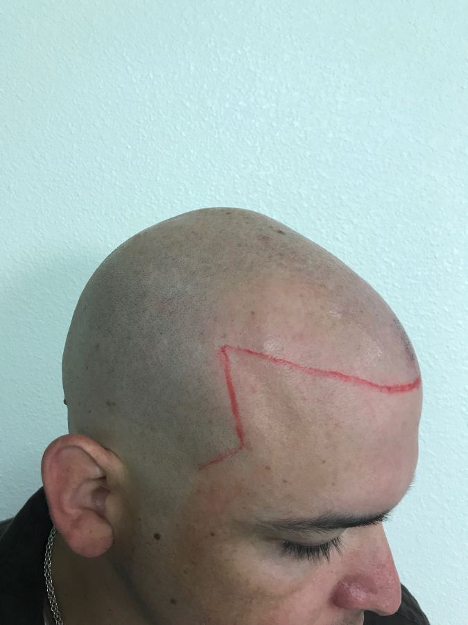 Scalp Micropigmentation Clinic in Las Vegas Scalp Micropigmentation Clinic in Las Vegas