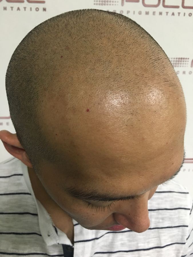 Scalp Micropigmentation Clinic in Vegas