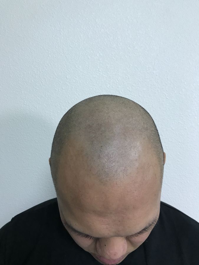 Scalp Micropigmentation Clinic in Las Vegas, NV