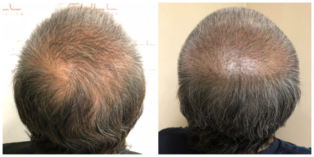 Scalp Micropigmentation Before and After 2 - FULL Micropigmentation Client Jang