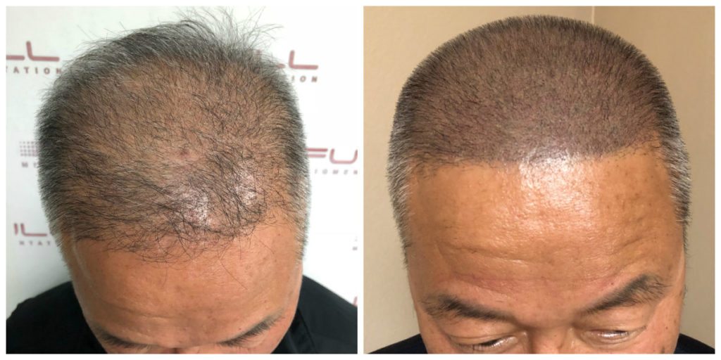 Scalp Micropigmentation Before and After 3 - FULL Micropigmentation Client Jang