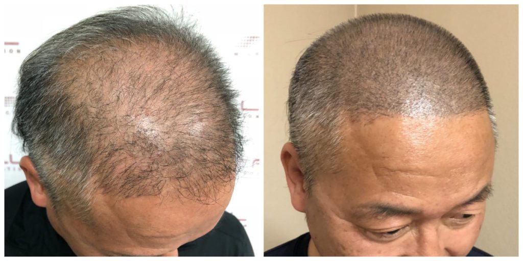 Scalp Micropigmentation Before and After 4 - FULL Micropigmentation Client Jang