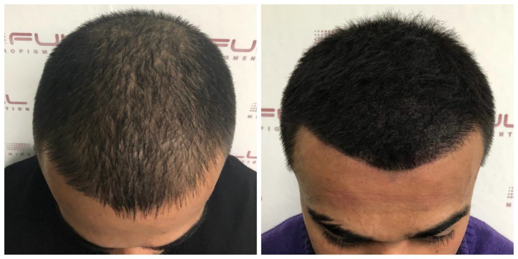 Scalp Micropigmentation Before and After - Client Gurpreet