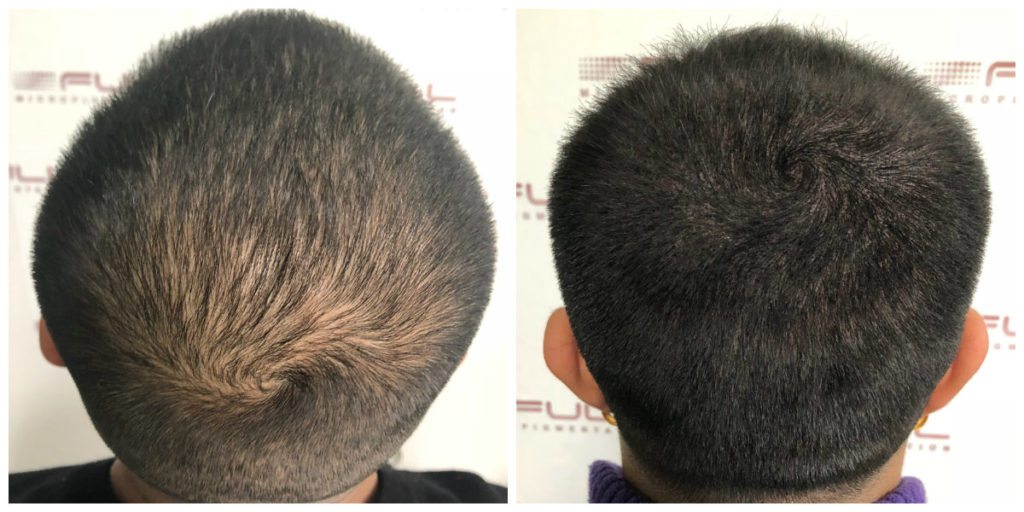 Scalp Micropigmentation Before and After - Client Gurpreet 2