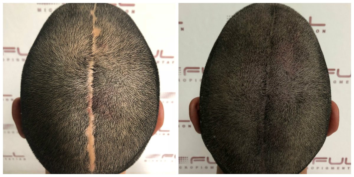 Scalp Micropigmentation Services in Las Vegas - FULL Micropigmentation Before and Ater 1