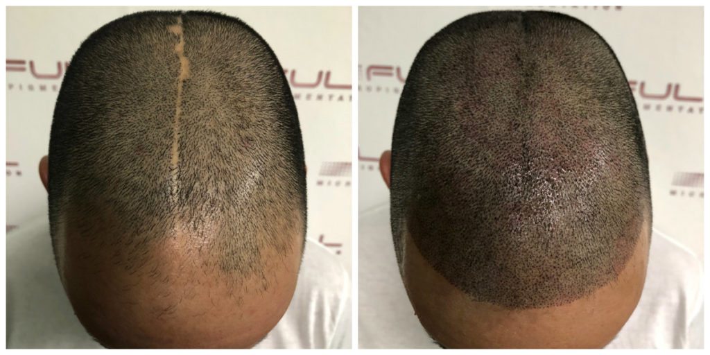 Scalp Micropigmentation Services in Las Vegas - FULL Micropigmentation Before and Ater 2