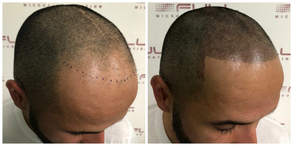 Scalp Micropigmentation Services in Las Vegas - FULL Micropigmentation Before and Ater 3