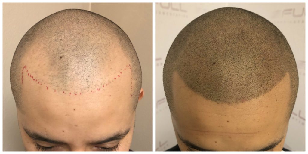 Before and After Scalp Micropigmentation Las Vegas, NV - Carlos M 1