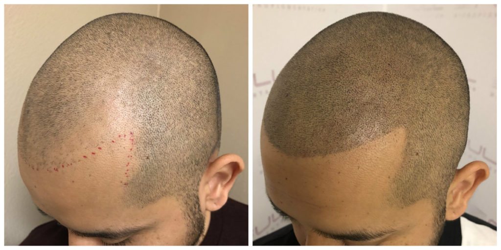Before and After Scalp Micropigmentation Las Vegas, NV - Carlos M 2