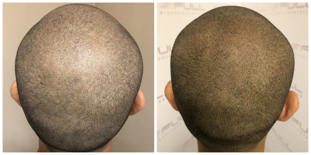 Before and After Scalp Micropigmentation Las Vegas, NV - Carlos M 3