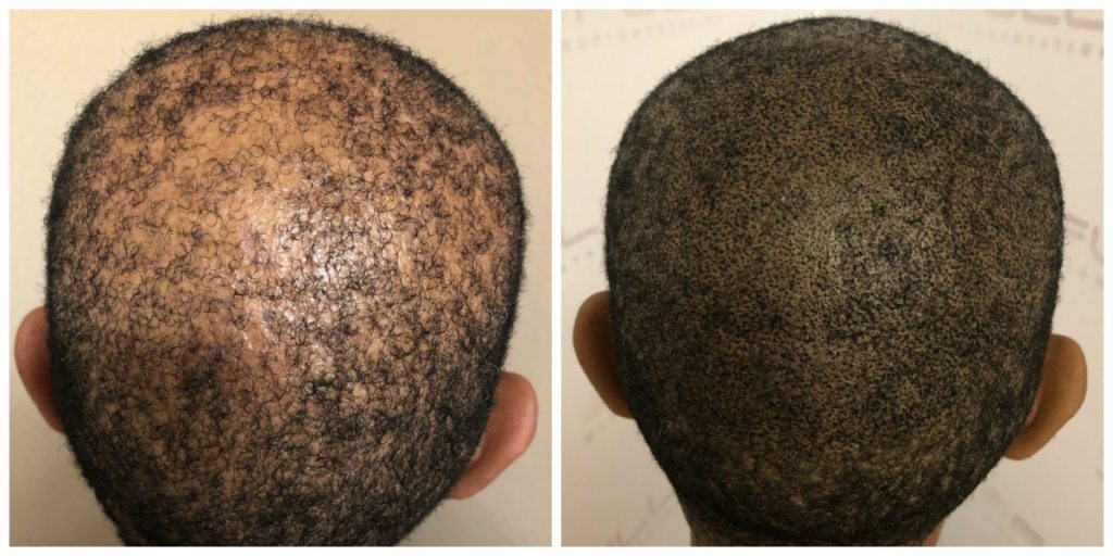Las Vegas Scalp Micropigmentation Before and After - Kim (1)