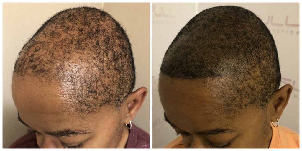 Las Vegas Scalp Micropigmentation Before and After - Kim (2)