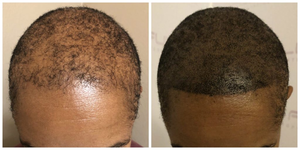Las Vegas Scalp Micropigmentation Before and After - Kim (3)