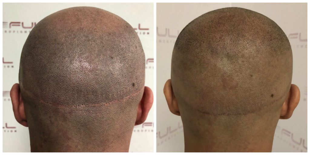 Mike Scalp Micropigmentation Before and After 3