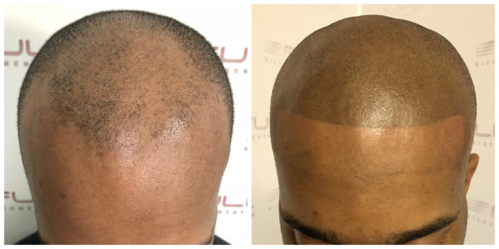 Sulaimon Scalp Micropigmentation Before and After 4