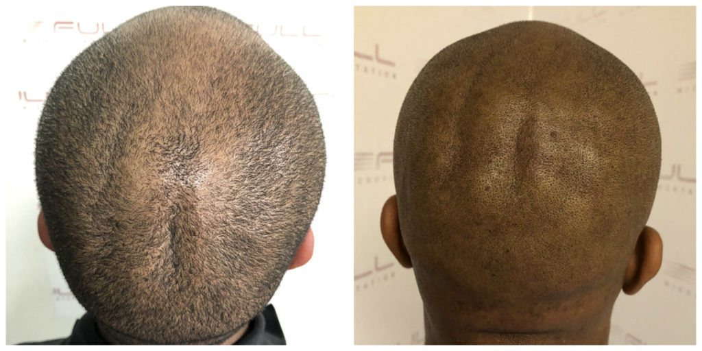 Sulaimon Scalp Micropigmentation Before and After 5