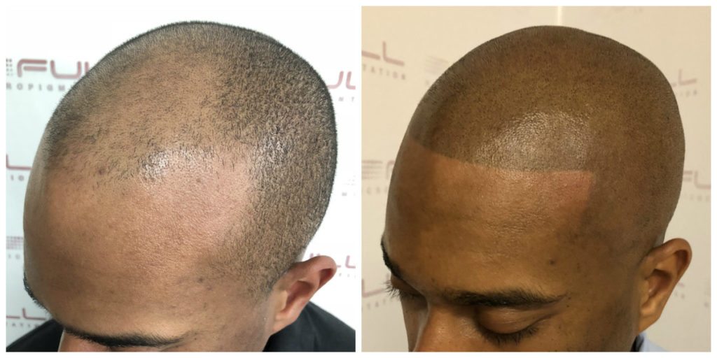Sulaimon Scalp Micropigmentation Before and After 6