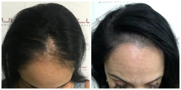 Scalp Micropigmentation For Women - Connie BA front