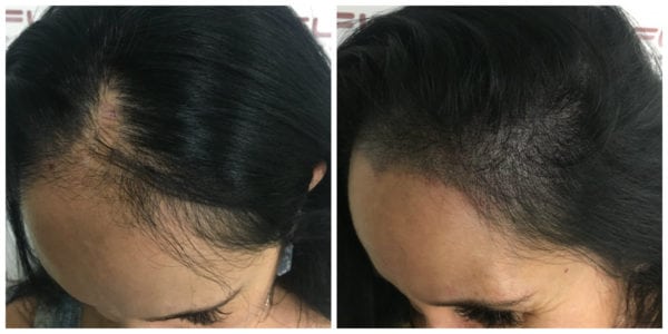 Scalp Micropigmentation For Women - Connie BA left side