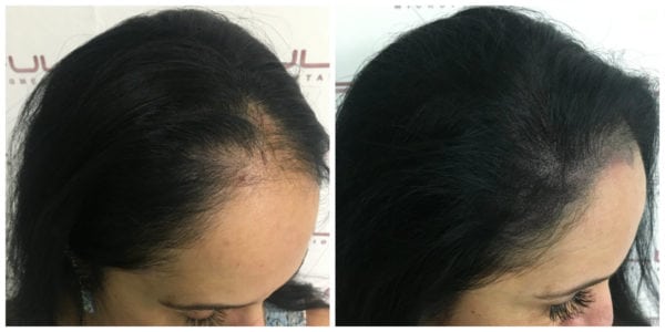 Scalp Micropigmentation For Women - Connie BA right side