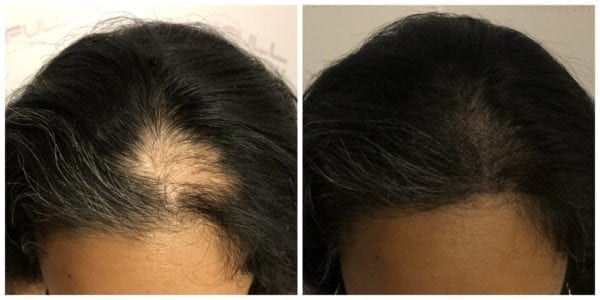 Alopecia Areata Hair Loss Treatment by Full Micropigmentation