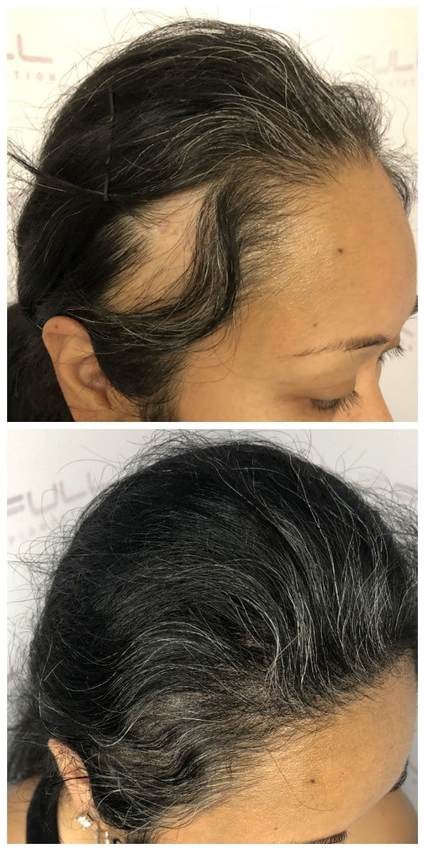 Alopecia Areata Hair Loss Treatment by Full Micropigmentation